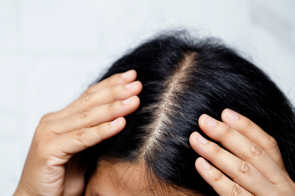 Soluciones efectivas para la alopecia: injerto y medicina capilar