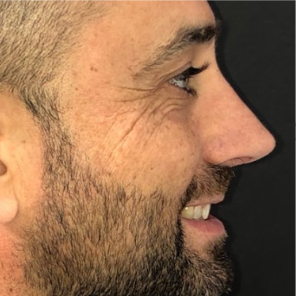 rinoplastia-antes-despues-dr-roderick-bonilla-kirurgio