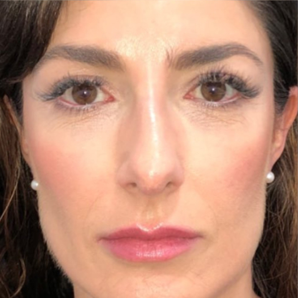 rinoplastia-cirugia-nariz-dr-roderick-bonilla-barcelona