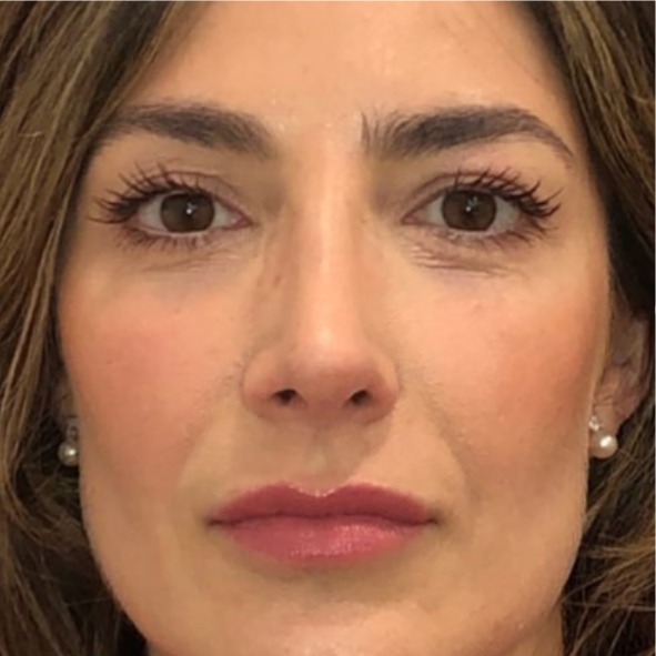 rinoplastia-cirugia-nariz-dr-roderick-bonilla-barcelona