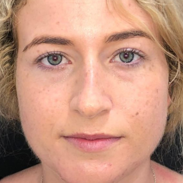 resultado-rinoplastia-dr-roderick-bonilla-kirurgio